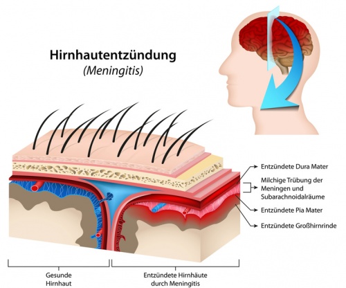 Wie äußert Sich Eine Hirnhautentzündung