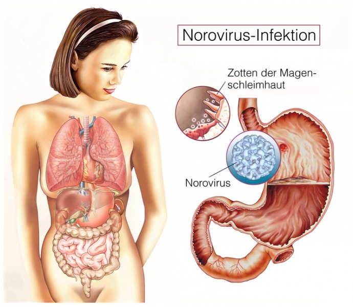 Datei:Norovirus-Infektion.jpg