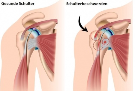 Steroid injection knee arthritis