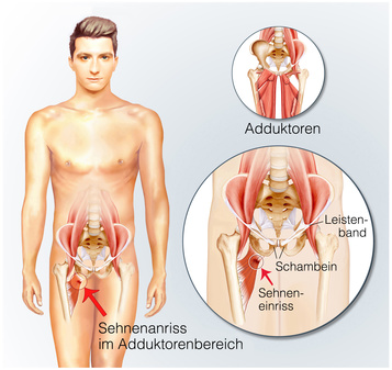 Adduktorenzerrung Ursachen Beschwerden Therapie Gesundpedia De