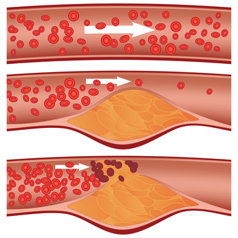 Arteriosklerose Verlauf