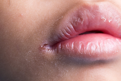 Cheilitis Ursachen Beschwerden Therapie Gesundpedia De