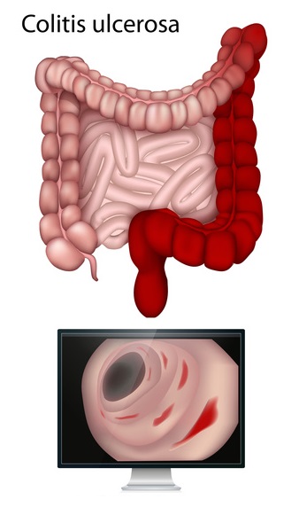 DateiColitis.jpg GesundheitsRatgeber & Lexikon Gesundpedia.de