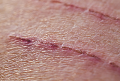 Entzündung - Ursachen, Beschwerden & Therapie | Gesundpedia.de
