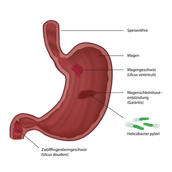Symptome Chronische Gastritis