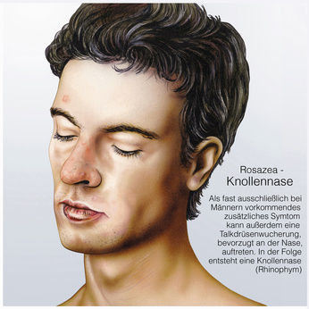 Rhinophym (Knollennase) - Ursachen, Beschwerden & Therapie | Gesundpedia.de