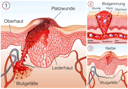 Platzwunde Ursachen Behandlung Vorbeugung Gesundpedia De