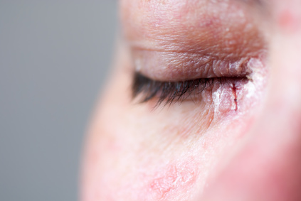 Schuppige Augenlider Ursachen Behandlung Vorbeugung Gesundpedia De