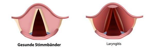 Wie Lange Nicht Rauchen Nach Stimmband Op Stimmbandentzündung - Ursachen, Beschwerden & Therapie | Gesundpedia.de