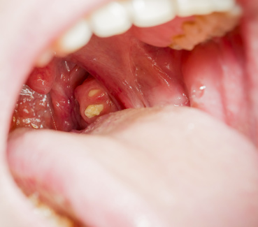 Tonsillitis Ursachen Beschwerden Therapie Gesundpedia De