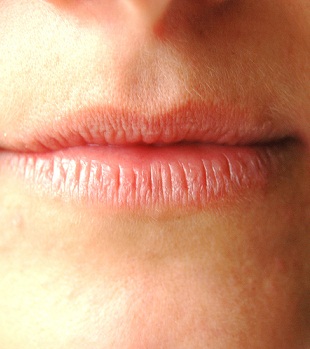 Lippe eingerissene Lippe in