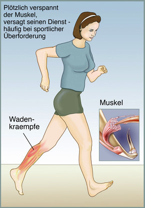 Wadenkrampf - Ursachen, Behandlung & Vorbeugung | Gesundpedia.de