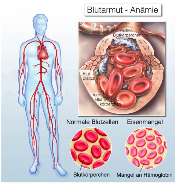Datei:Anämie.jpg
