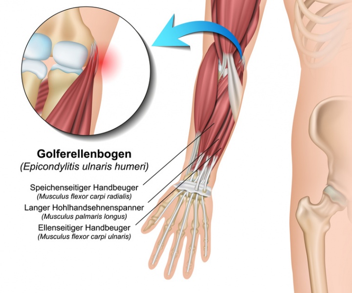 Datei:Golferellenbogen.jpg