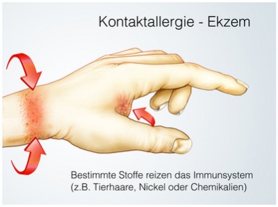 Waschmittelallergie Ursachen Beschwerden Therapie Gesundpedia De