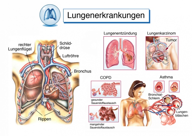 Datei:Lungenerkrankungen.jpg