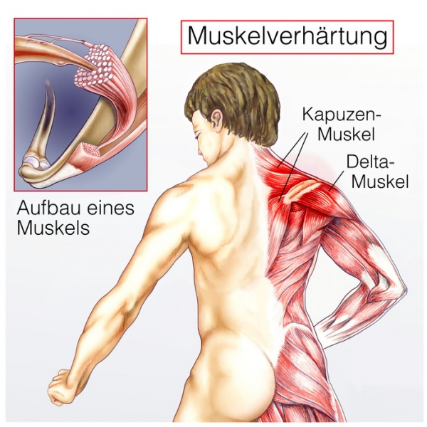 Datei:Muskelverspannung.jpg