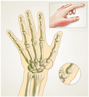 Wie finger lange verstaucht Finger verstaucht