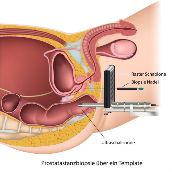 Datei:Prostata-Biopsie.jpg