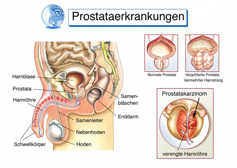Datei:Prostataerkrankungen.jpg