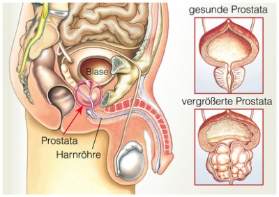 benigne prostatahyperplasie járás prosztatitis
