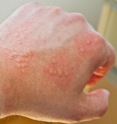 Eichenprozessionsspinner Allergie Ursachen Beschwerden Therapie 