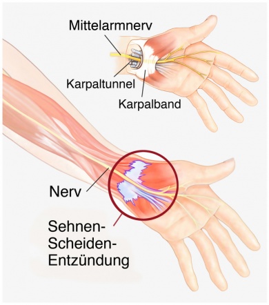 sehnenscheide-funktion-aufbau-beschwerden-gesundpedia-de